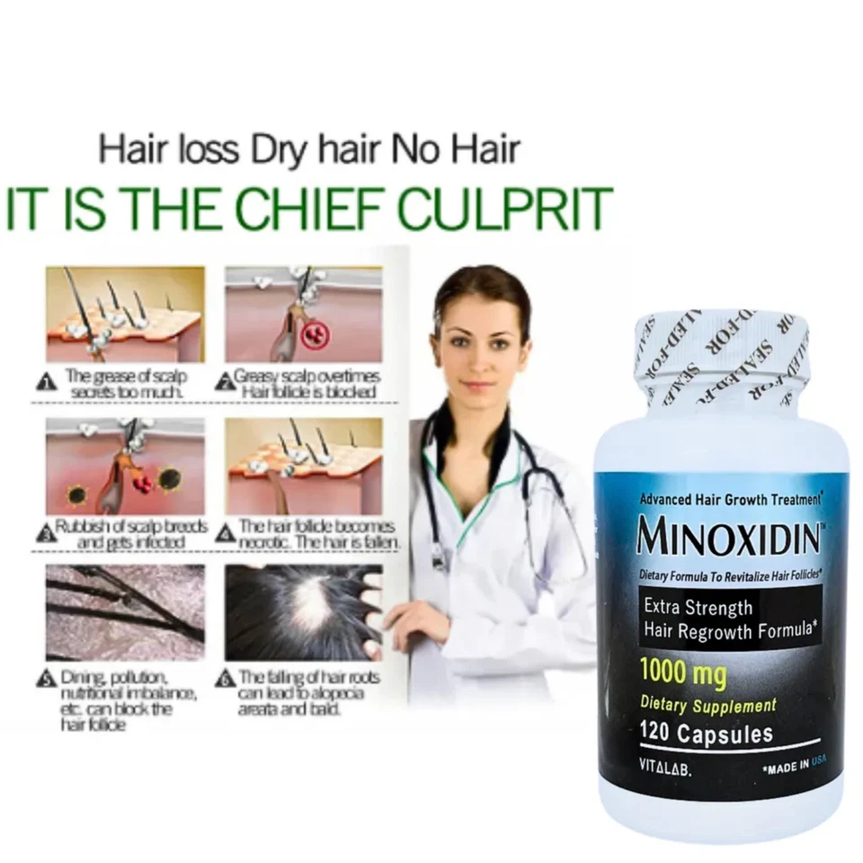 Minoxidina 1000mg Suplemento para el Crecimiento del Cabello - 120 Cápsulas Tratamiento Anti Pérdida de Cabello Foto 4 de 4