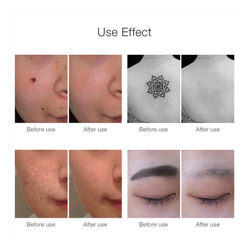 Penna laser professionale picosecondi blu e rossa rimozione tatuaggi acne talpa cicatrici detergente - Foto 11 di 17