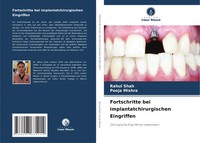 Fortschritte Bei Implantatchirurgischen Eingriffen Rahul Shah (U. A.) Buch 2024