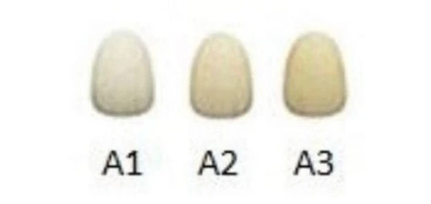 Prótese completa superior e inferior personalizada (conjunto completo de acrílico) - Imagem 4 de 4