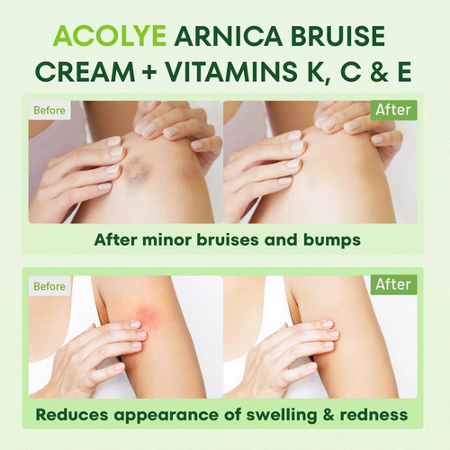 CREMA ARNICA PARA MORETONES E HINCHAZÓN CREMA EXTRA FUERTE PARA MORETONES DE ÁRNICA - Imagen 2 de 7