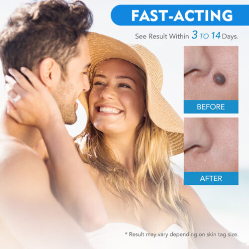Electrico Laser Verrugas Quita Entferner Stift Para Mezquinos Elimina Pecas Maquina - Bild 25 von 27