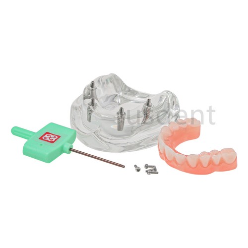 All on 4 Dental Implant Model Overdenture Upper Jaw 4 Implant Clear Detachable - Picture 13 of 16