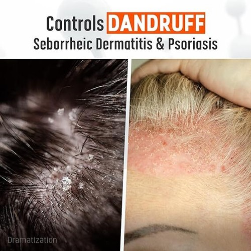 Medicasp Coal Tar Gel Dandruff Shampoo to Treat Seborrheic Dermatitis Psoriasis, - Picture 2 of 6