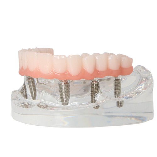 Demo Overdenture All On 4 & All On 6 treatment Dental Implant Model 4/6 Screws - Picture 39 of 83