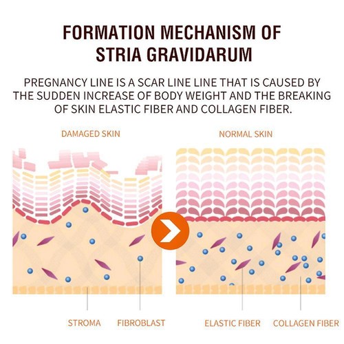 Stretch Mark Remover Repair Cream Postpartum Pregnancy Removal Care Skin G1V7 - Bild 7 von 14
