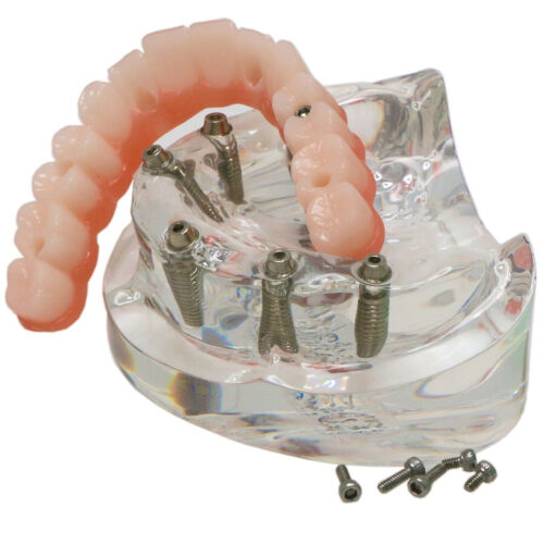 Implante dental todo en 6 sobredentadura modelo demostración mandíbula superior 6 tornillos transparente M6001-2 - Imagen 10 de 11
