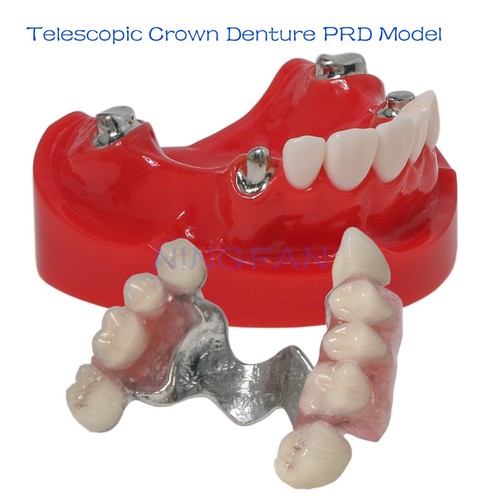 Dental RPD Prótesis Parciales Extraíbles Modelo Typodont lmplant Modelo - Imagen 14 de 35