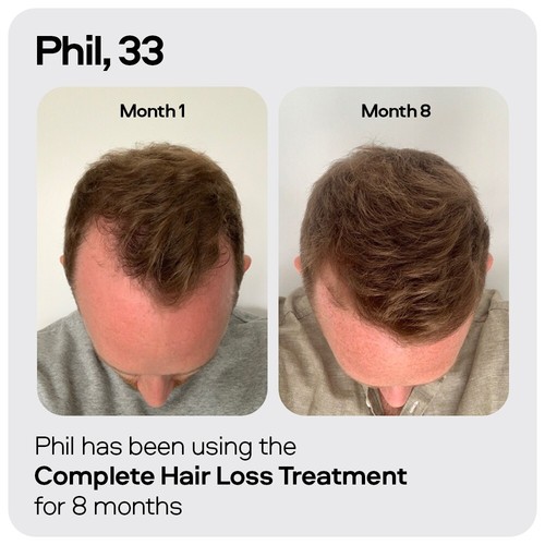 Topical Minoxidil 5% Men Sons UK Licensed for Scalp/Hair Loss Treatment - 60ml - Picture 3 of 13