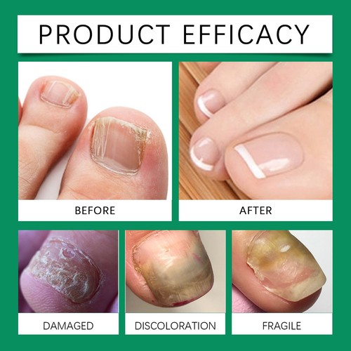 Nailshield Anti Fungal Stick,Monsalife Nail Shield Anti Fungal Stick Roll On UK - Picture 15 of 22