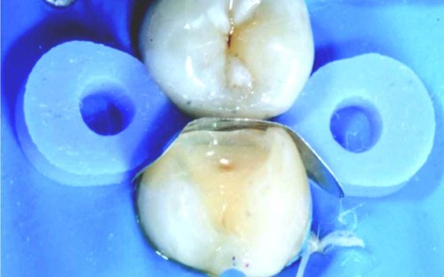 Dental TOR VM Saddle Sectional Contoured Matrice Matrix Bands Ring/Wedges/Plier - Picture 9 of 282