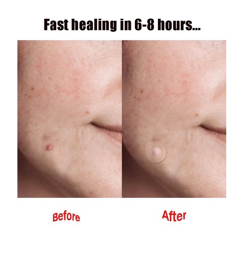 Acne Banish | Acne Spot Dots | Hydrokolloid I 36 Aknepflaster - Bild 5 von 6