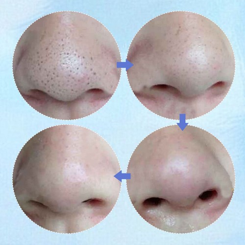 50/100pcs Nose Pore Strips Blackhead Removal Unclog Pores Smooth Deep Cleansing - Picture 9 of 13