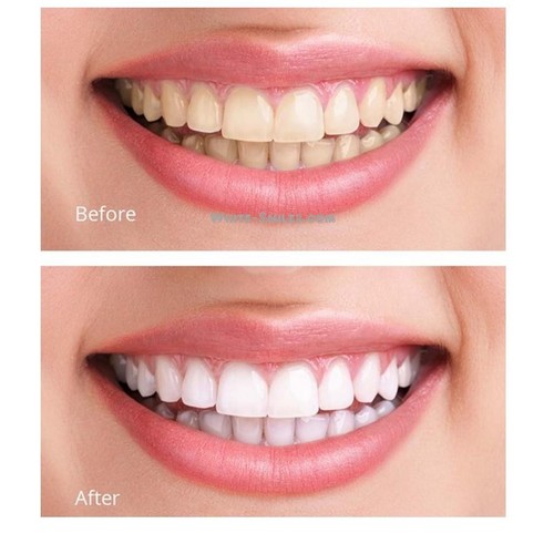TEETH WHITENING KIT TOOTH WHITENER BLEACH WHITE DENTAL GRADE GEL STRONG KIT - Picture 5 of 24