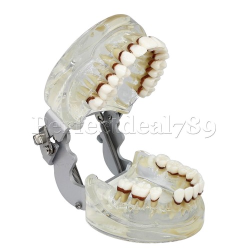 Dental Orthodontics Implant Study Model Analysis Demonstration Tooth Teaching - Picture 133 of 158