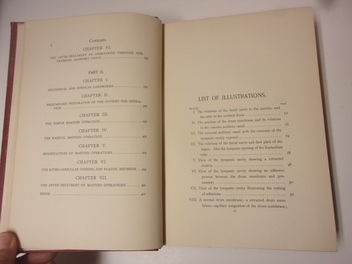 The Surgical Treatment of...the Middle Ear and Mastoid, Seymour Oppenheimer 1906 - Picture 10 of 16
