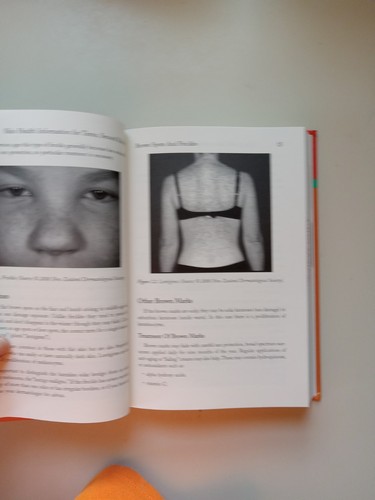 Skin Health Information for Teens : Health Tips about Dermatological Concerns... - Picture 22 of 24