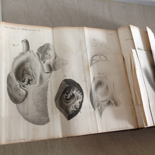 BOUILLAUD/ TRAITE des MALADIES DU COEUR/TOME IIe seul/6 planches H-T /1841 - Imagen 9 de 12