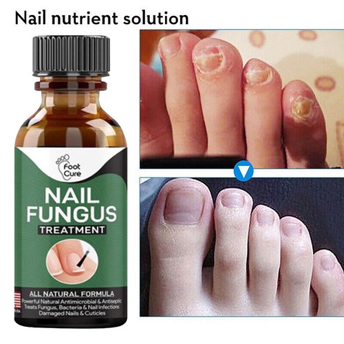 Nail Fungus Treatment Essence Serum Care Hand and Foot Care Removal Repair Gel - Picture 9 of 12