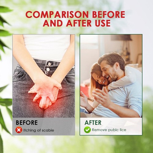 Pubic Lice Anti-itch Cream, Personal Care Cream & Itching 20g -Cream L2X8 - Picture 4 of 11