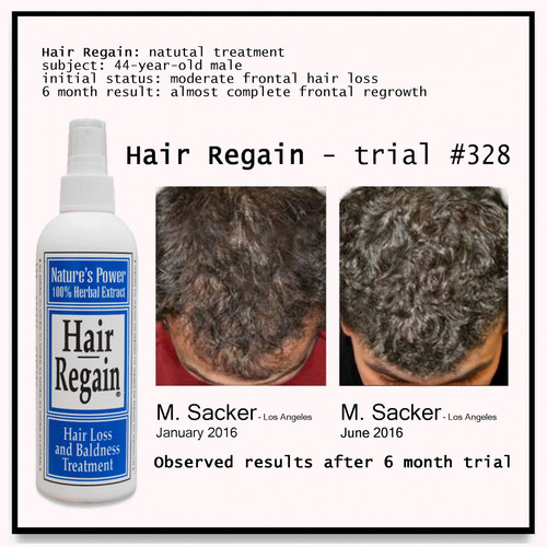 2 month HAIR REGAIN MENS HAIR LOSS REGROWTH TREATMENT start male pattern growth 713757677936 | eBay 2 month HAIR REGAIN MENS HAIR LOSS REGROWTH TREATMENT start male pattern growth 713757677936 | eBay