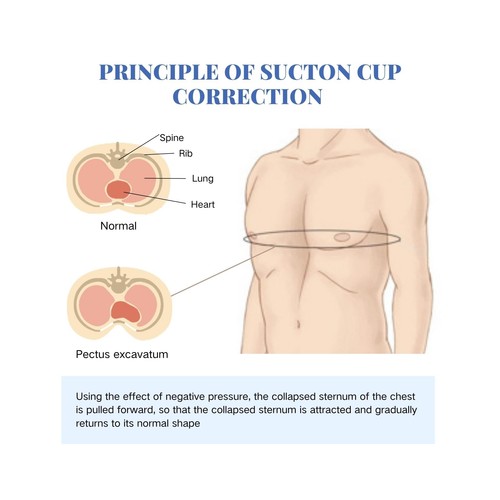 Pectus Excavatum Orthosis Brace, Pectus Excavatum Vacuum Bell, Sternal Depres... - Picture 3 of 7