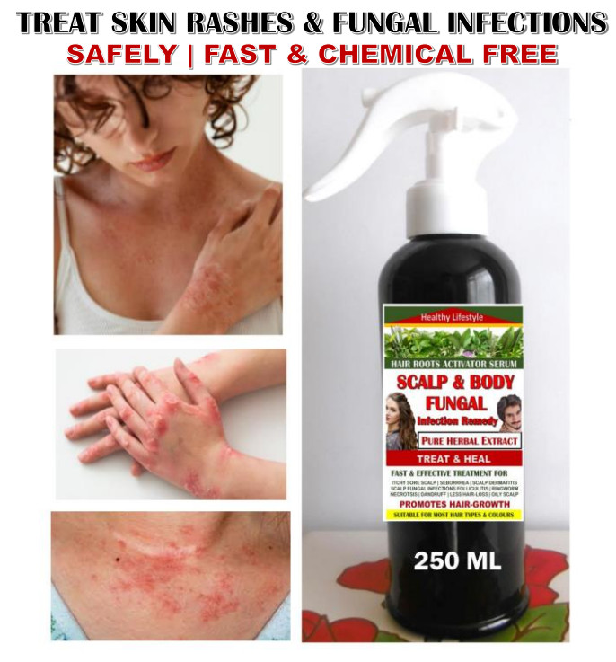 TREAT & CURE SCALP FUNGAL INFECTIONS Hair-Loss Dandruff - Herbal Extract 250 ML