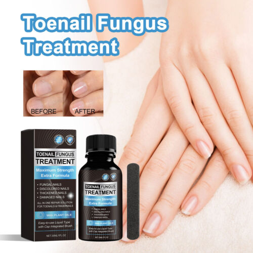 Finger Nail And Toe Nail Fungus Treatment Extra Strength 30ML Natural Treatment - Picture 4 of 14