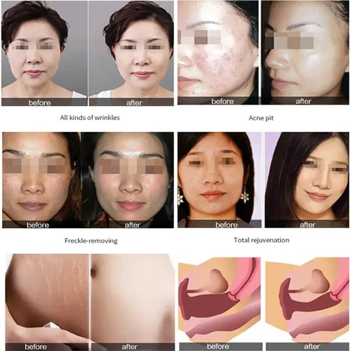 Laser CO2 frazionato PRO ringiovanimento pelle rimozione smagliature macchina cicatrici acne - Foto 3 di 6