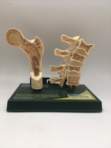 Fosamax Femur and Spine Cross section Anatomical model pharmaceutical - Picture 1 of 2