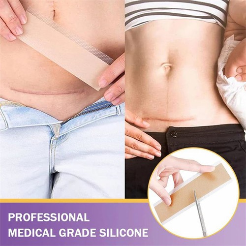 Fogli di cicatrici in silicone acido ialuronico, nastro cicatrice in silicone foglio morbido e confortevole - Foto 9 di 12
