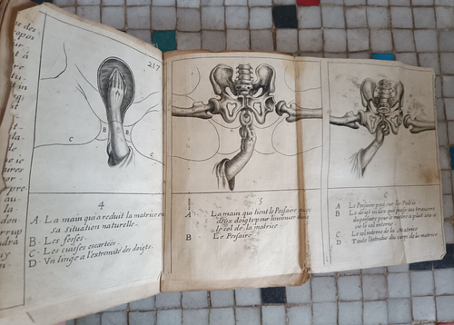 Beobachtungen zur Praxis der Naturgeburten Viardel Geburtshilfe 1673 - Bild 9 von 12
