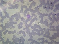 Balantidium Coli Trophozoites; Smear