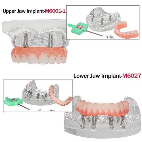 US Dental Overdenture Restoration Teeth Model With 4/6 Screws Upper/Lower Jaw - Picture 54 of 56