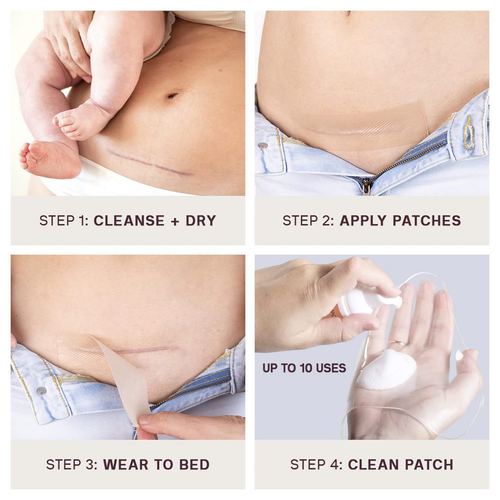 C-Section Scar Patch - Pregnancy Stretch Mark Prevention & Removal, C Section Co - Picture 3 of 12