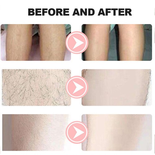 2 in 1 Picosekunden Diodenlaser Tattoo & Haarentfernungsgerät 808/755/1064nm - Bild 11 von 13