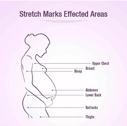 New Mederma Stretch Marks Removal Cream Scars Therapy Cream Paraben Free 25g - Picture 5 of 5