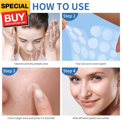 Pimple Patches for Face, 4 Size 300 Counts Acne Patches, Hydrocolloid Patches fo - Picture 8 of 8
