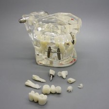 1pc Dental Implant Analysis Demonstration Teeth Disease Model Bridge Restoration