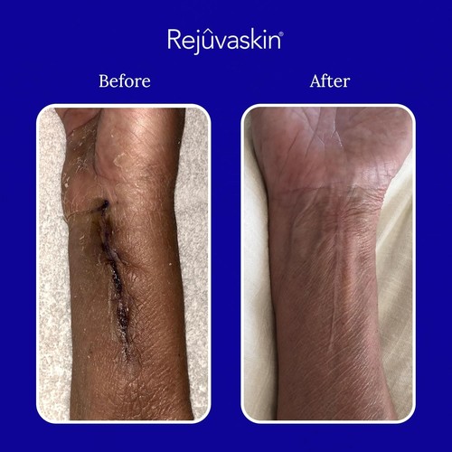 Rejuvaskin Scar Heal Kits EXP 02/2030 - Picture 5 of 5