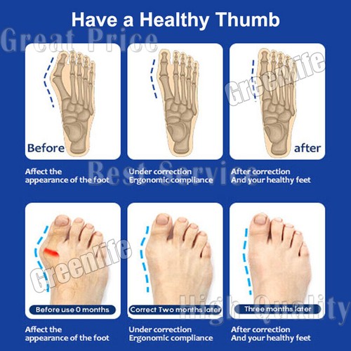 Adjustable Hallux Valgus Bunion Corrector Splint Straightener Toe PainRelief - Picture 14 of 17