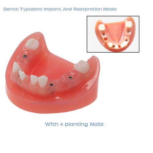 Implantat Prothesen-Set für Hiossen Osstem, Dental TS Knochenprofiler Instrument - Bild 16 von 88