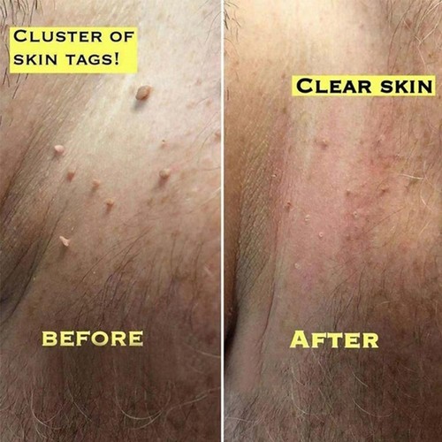 3ml Skin Tag Remover Wart Remover Liquid Quickly Remove Common And Plantar W BAK - Bild 8 von 11