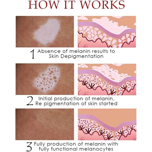 Timilk Viticlear Vitiligo Spray, Tratamiento Vitiligo, Crema Tratamiento Vitiligo - Imagen 6 de 9