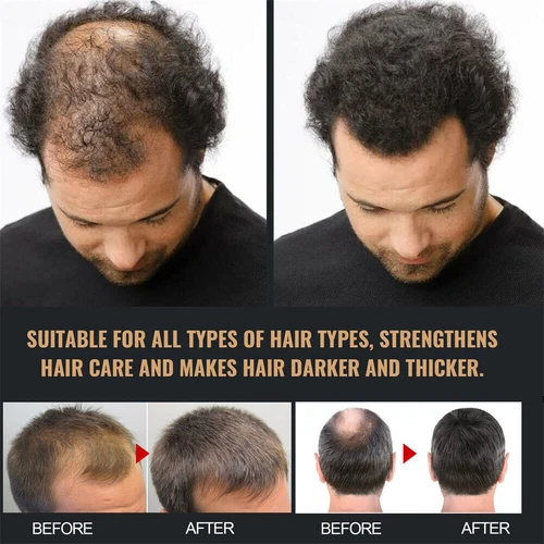 1-5X Root Activator Shampoo, SPARTAN Hair Loss Shampoo,Shampoo Root Activator - Picture 5 of 9