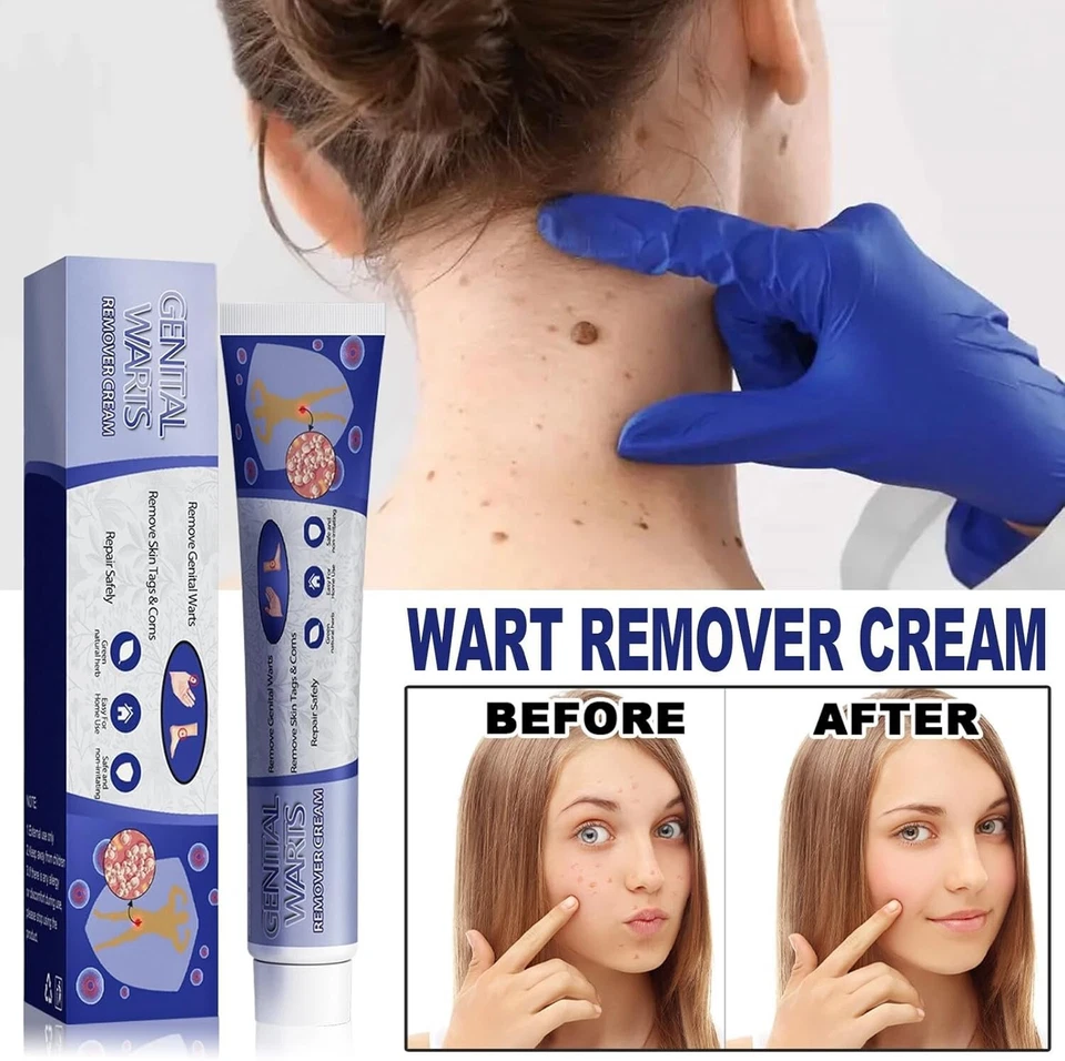 Skin Tag Mole Wart Remover Removal Cream Ointment Fast Safe Natural Treatment