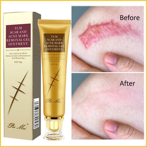 Crème anti-cicatrices d'acné 30 g boutons vergetures gel visage enlever V5E0