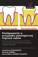 Post¿Powanie W Przypadku Patologicznej Migracji Z¿BóW Meriem Benali