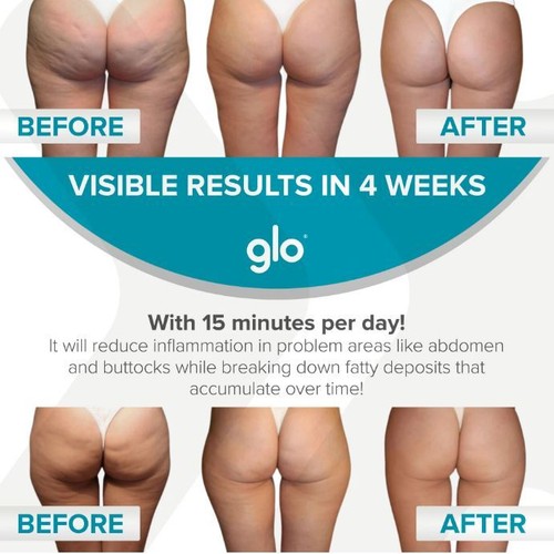 Glo 910+ Glo910+ Anti Cellulite Massager w/Phototherapy for Exfoliation/Drainage - Picture 7 of 7