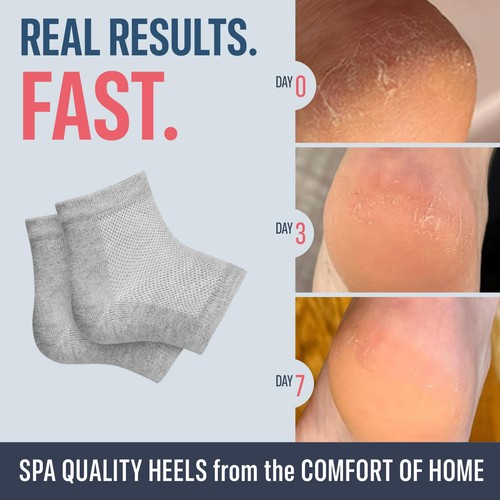 Moisturizing Heel Socks for Cracked Heel Treatment - 2 Pairs - Stop Cracked H... - Picture 2 of 8
